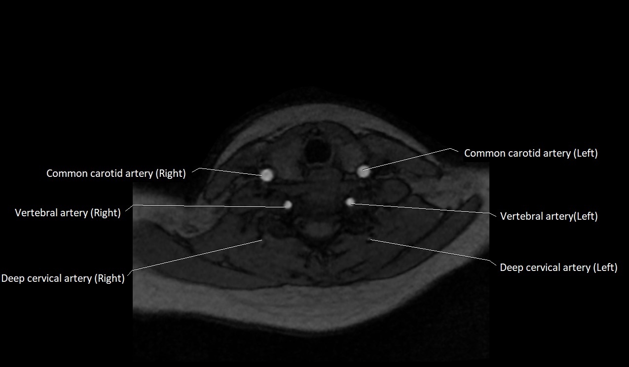 Carotid artery anatomy axial 3T image 49.jpg